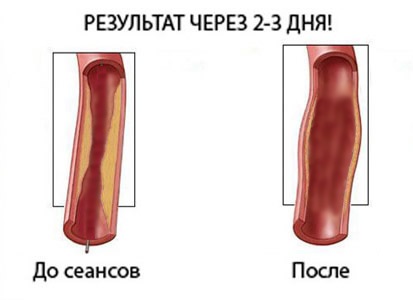 Cea mai importantă hipertensiune arterială este tratamentul cardiac