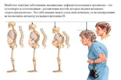 Osteomalacia - simptome și tratamentul bolii