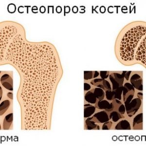 Osteoporoza, secția de endocrinologie a Spitalului Central al Președintelui Federației Ruse