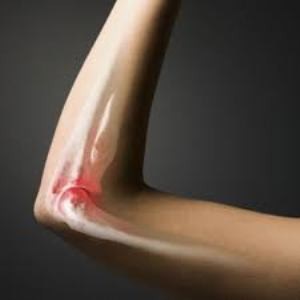 Depunerea de sare în articulațiile mâinilor - simptome și cum trebuie tratate