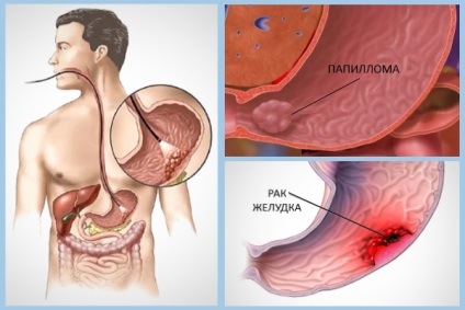 Papilomii în stomac, cum să tratezi și să tratezi remedii folclorice