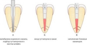 Semănarea canalelor radiculare, totul despre parodonție