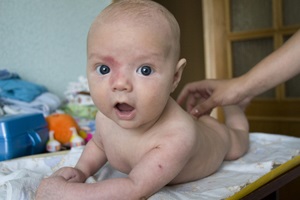 De ce apare hemangiomul la nou-născuți?