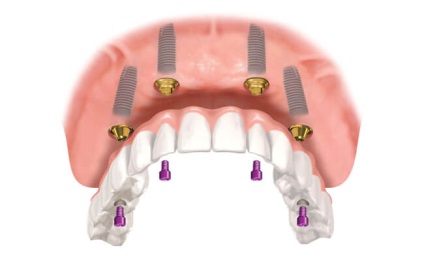 Proteza de acoperire pe implanturi - indicații, instalare, prețuri