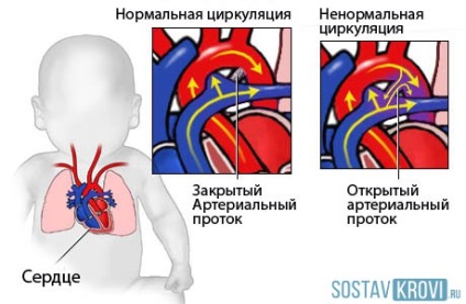 Boala cardiacă la copii ce este, cauze, simptome, până la un an, tratament, funcționare