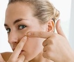 След лечение на акне отлепете кожата - статии за жени