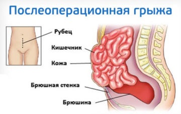 Hernia postoperatorie cauzează, simptome, diagnostic și tratament