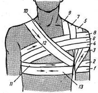 Bandaje pe membrele superioare - desmurgie - boli chirurgicale - chirurgie - cititor de miere