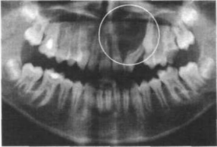 Cauzele și simptomele unui chist dentar - cum se identifică și ce este o boală periculoasă