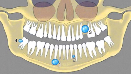 Cauzele și simptomele unui chist dentar - cum se identifică și ce este o boală periculoasă