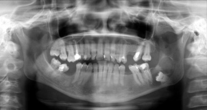 Cauzele și simptomele unui chist dentar - cum se identifică și ce este o boală periculoasă