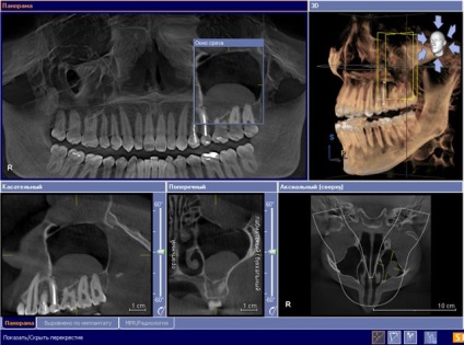 Cauzele și simptomele unui chist dentar - cum se identifică și ce este o boală periculoasă