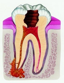 Cauzele și simptomele unui chist dentar - cum se identifică și ce este o boală periculoasă