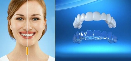 Priimuschestva és hátrányait fogak igazítás Invisalign breketamy