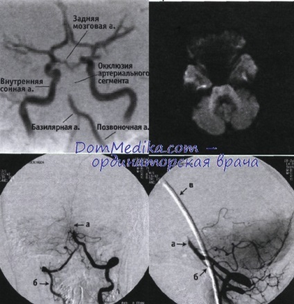 Exemplu de tromboliză a trombozei în artera bazilară