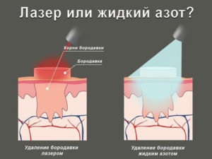 Cauterizarea negilor cu azot lichid Cryodesculare sau îndepărtarea cu laser