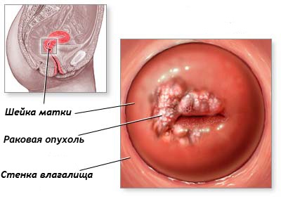 Рак шийки матки на узі (видно чи)