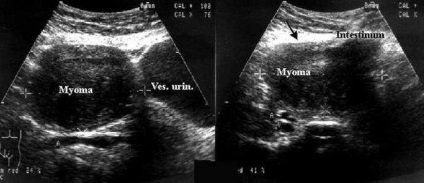 Cancerul de col uterin în uzi (poate fi văzut)