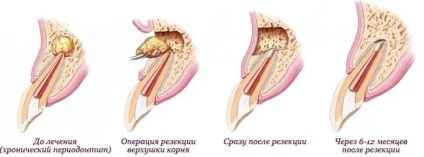 Resectionarea vârfului rădăcinii dintelui - care este prețul în 2017, revizuirile pacienților, complicațiile ulterioare