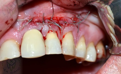 Resectionarea vârfului rădăcinii dintelui - care este prețul în 2017, revizuirile pacienților, complicațiile ulterioare