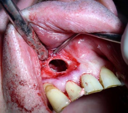 Resectionarea vârfului rădăcinii dintelui - care este prețul în 2017, revizuirile pacienților, complicațiile ulterioare