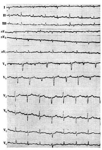 Szívbetegségek alternans - Klinikai Cardiology h