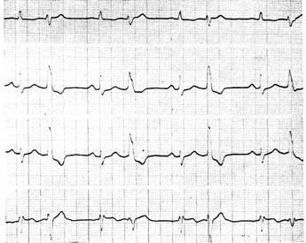 Szívbetegségek alternans - Klinikai Cardiology h