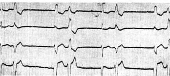 Szívbetegségek alternans - Klinikai Cardiology h