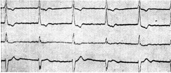 Szívbetegségek alternans - Klinikai Cardiology h