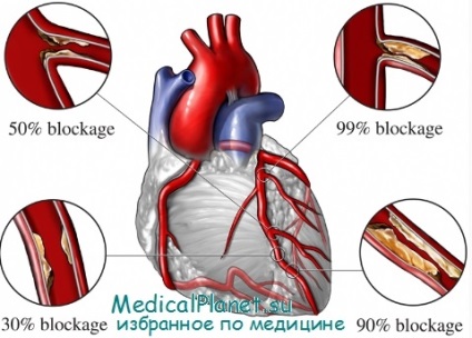Bolile cardiovasculare la vârstnici