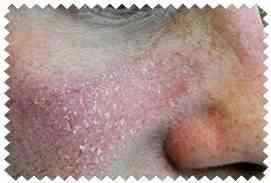 Pikkelyes, viszkető bőr az arcon - akne kezelés - cikkek Directory - hogyan lehet szép