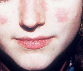 Scaldă fața cu aspectul de acnee, motivele pentru fotografie