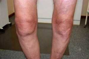 Simptomele, cauzele și tratamentul artrozei articulației genunchiului