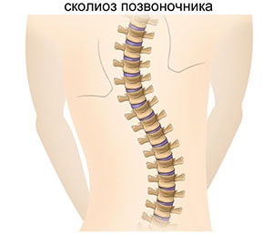 Scolioza coloanei vertebrale - ceea ce trebuie să știți