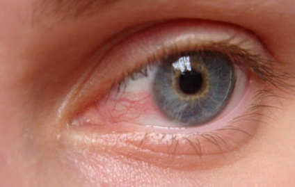 Ochii sunt orbi - cauzele sunt tratate cu remedii populare și specialiști