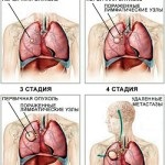 Temperatura în stadiul 4 de cancer pulmonar numai seara după chimioterapie