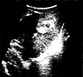 Diagnosticul transvaginal cu ultrasunete pentru endometrita postpartum