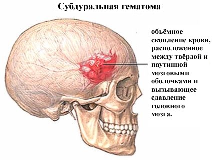 Diagnosticul traumatismului capului, consecințe, hemoragii