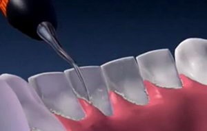 Ultrahangos tisztítás a fogak - a szakmai és biztonságos - mintegy harapás korrekciója és fogszabályozó