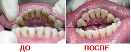 Ultrahangos tisztító fogak - ár, vélemények, előnyök és ellenjavallatok az fogtisztítás