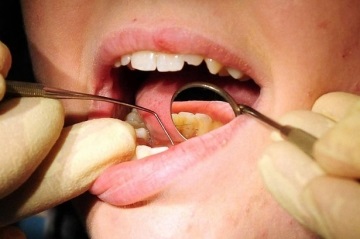 Ultrahangos tisztító fogak - ár, vélemények, előnyök és ellenjavallatok az fogtisztítás