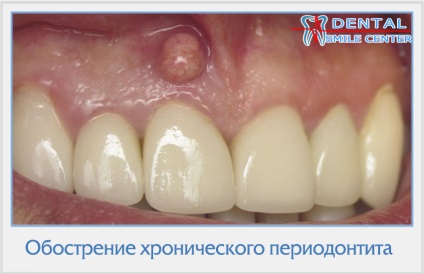 Alegerea analgeziei în periodontită apicală