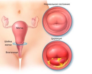 Eroziunea cervicală patologică și normală