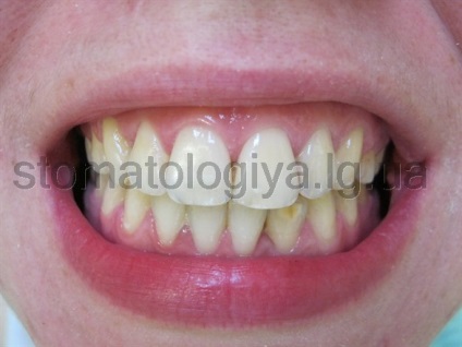 Rezultatele alinierii dinților