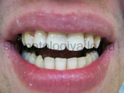 Rezultatele alinierii dinților