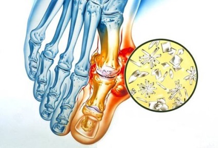 az ízületi gyulladások, a nagylábujj - Arthritis