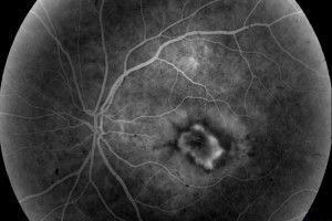 Distrofia chorioretinală a ochiului - cauze, simptome și tratament