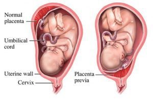 Întârzierea în uterul placentei și a părților sale