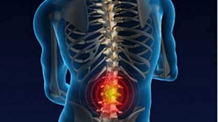 Strângerea nervului în simptomele și tratamentul coloanei vertebrale