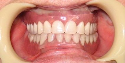 Proteze dentare din plastic, indicații pentru instalare, îngrijire